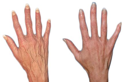 Effect of Neoveris for the treatment of varicose veins in the hands. 